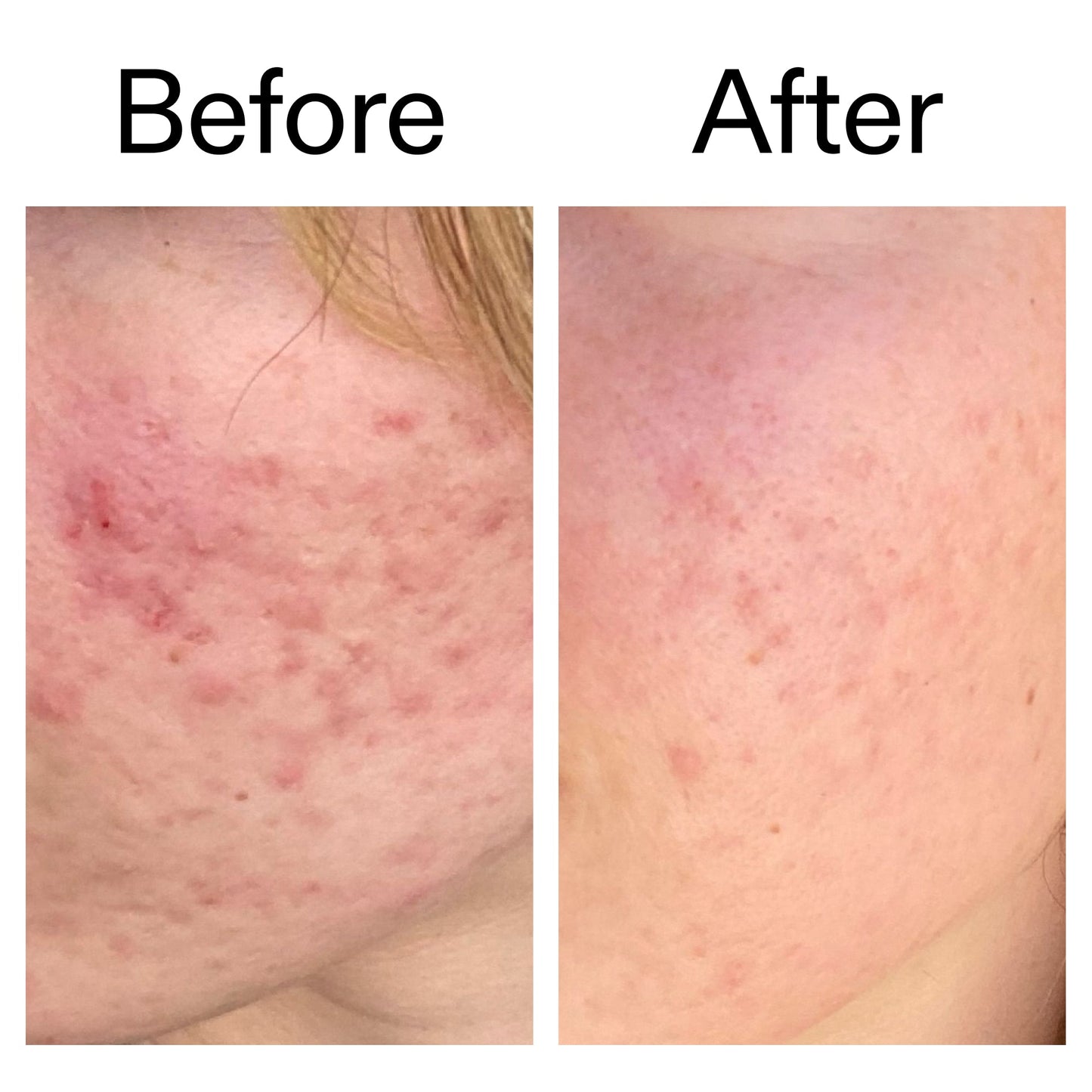 10-azelaic-acid-serum-for-redness-relief-x0 Azealic_Acid_Serum_B_A_Ppage_2000_x_2000.jpg