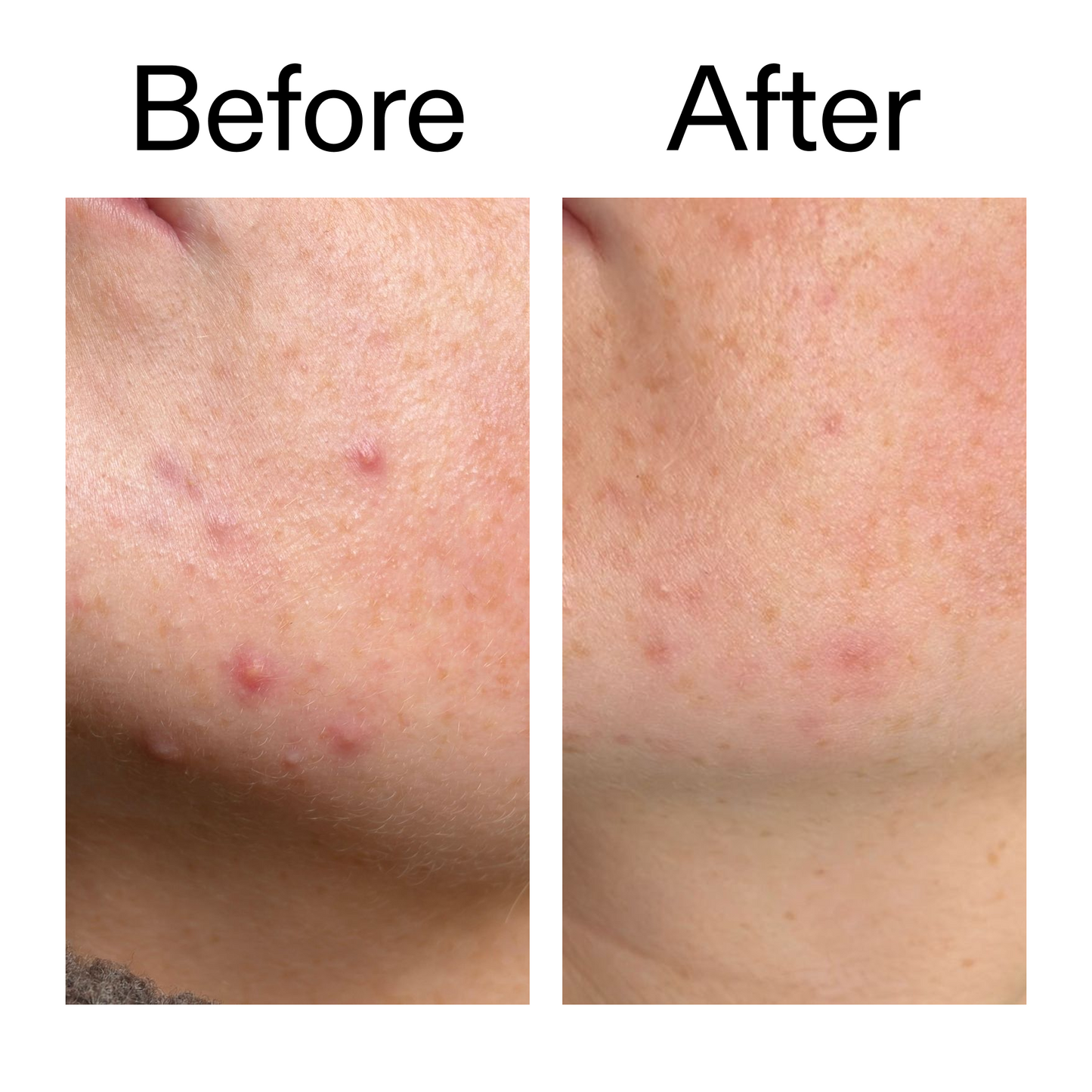 10-azelaic-acid-serum-for-redness-relief-x0 B_A_1_PPAGE.png