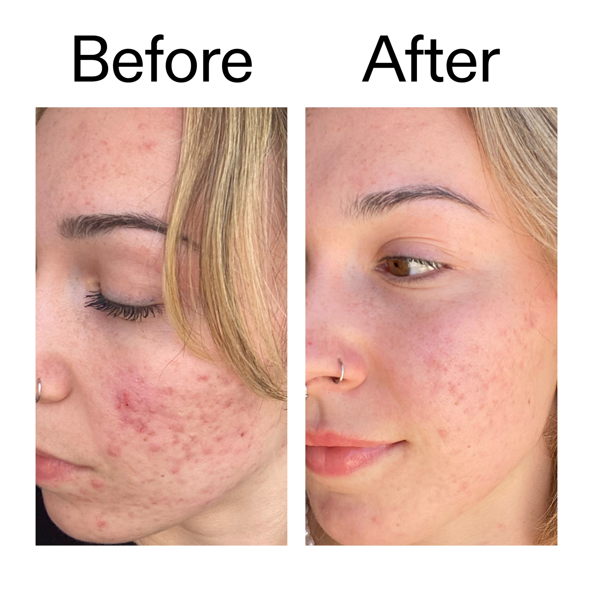 10-azelaic-acid-serum-for-redness-relief-x0 B_A_2_PPAGE.png