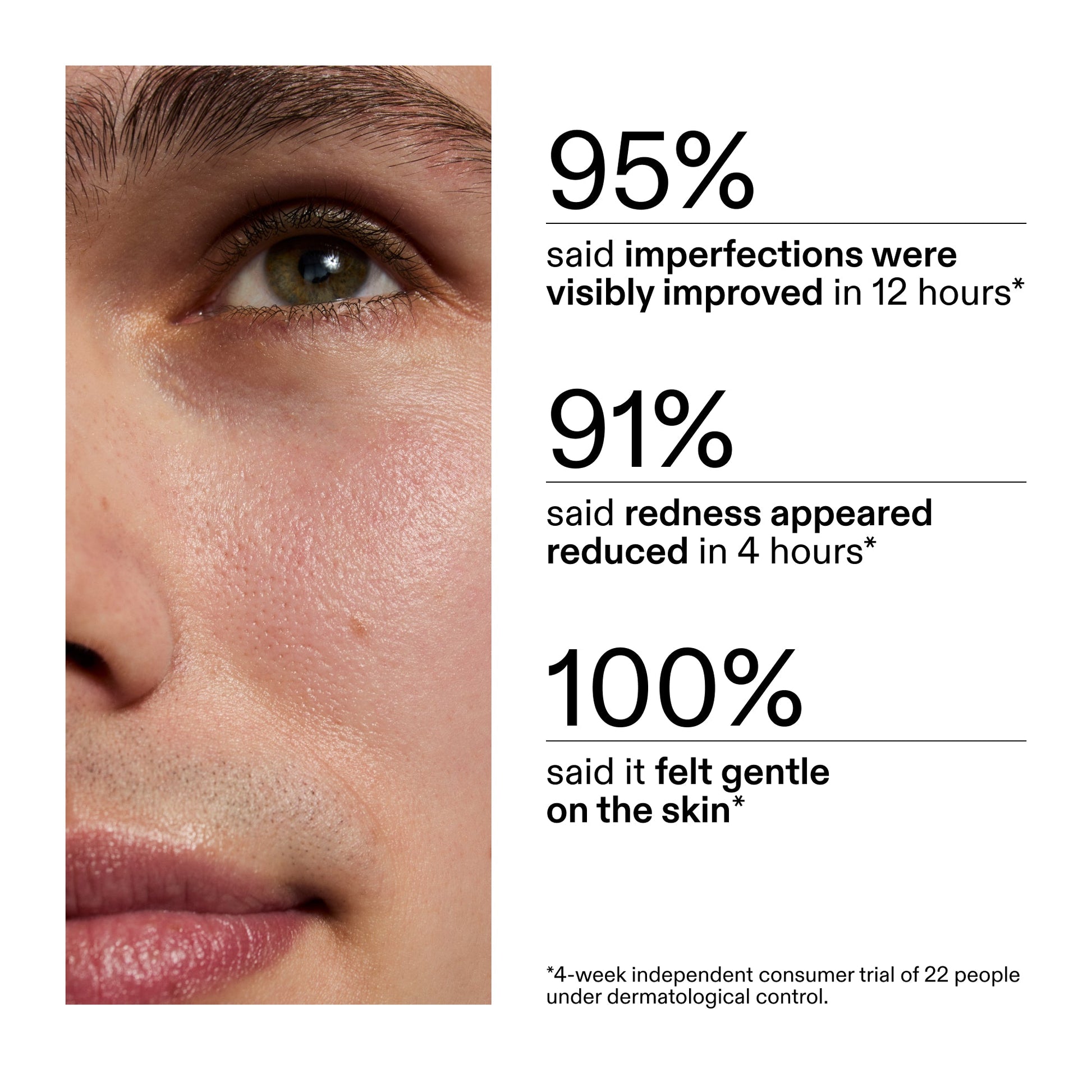 succinic-acid-acne-treatment-t3 CA_Succinic_Acid_Treatment_key_Claims_2000x2000_db91b0f1-7f29-4bfe-bb16-63a47f500960.jpg