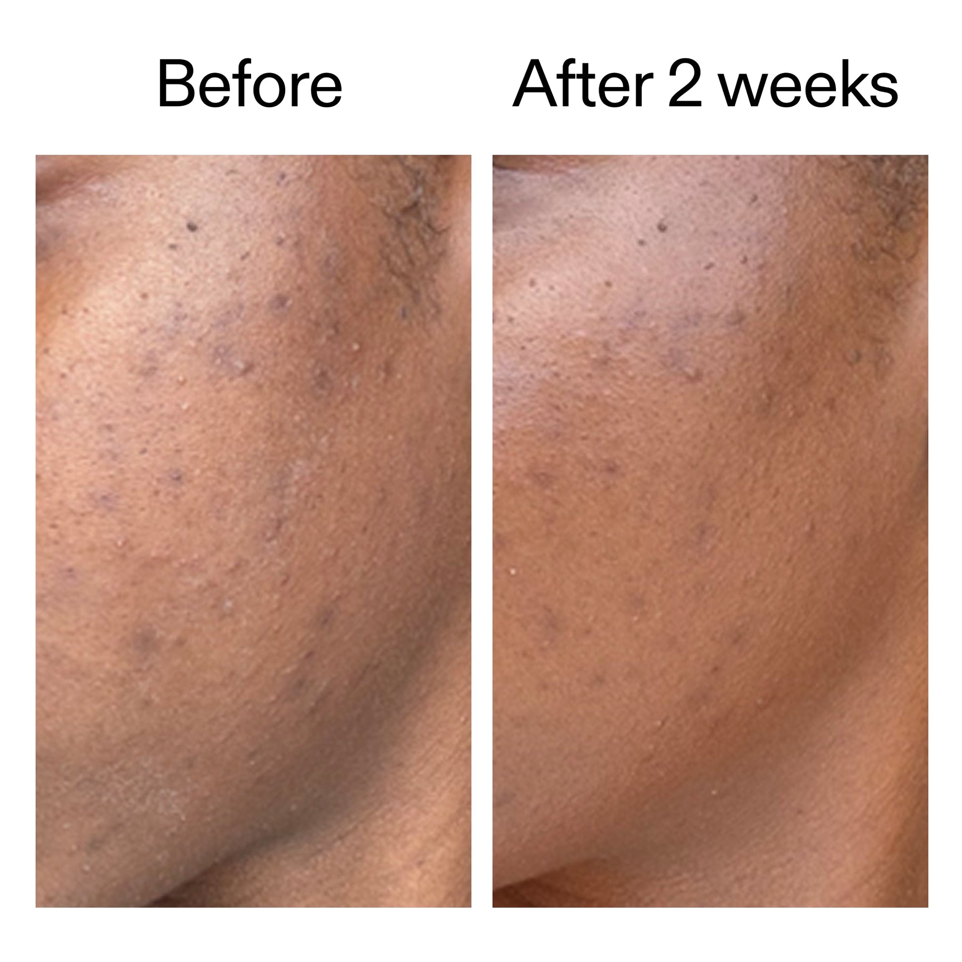 360-acne-clearing-serum-r2 DIOICB_A2000x2000.jpg