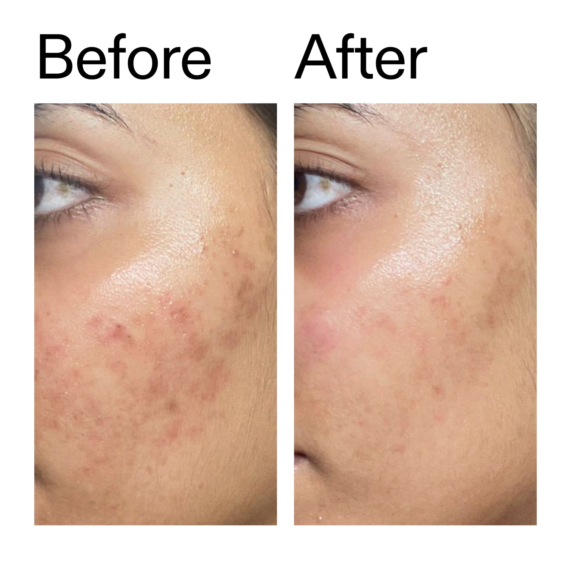 ectoin-hydro-barrier-serum-duo-i3 Ectoin_Hydro-barrier_Serum__Before_After_2000x2000_34261920-d004-48d0-9c7b-8e1c15971bfd.jpg