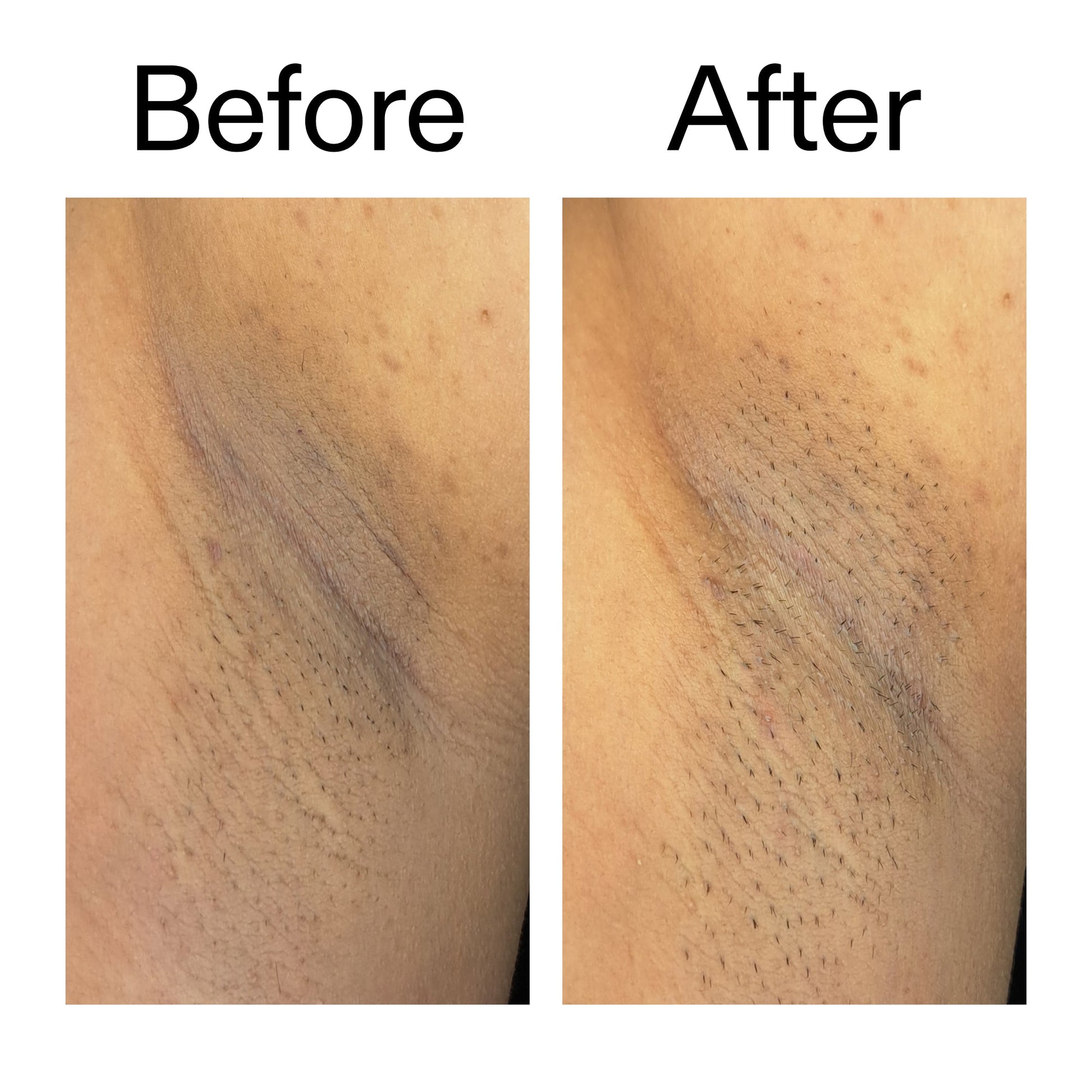 glycolic-acid-exfoliating-body-stick-j8 Glycolic_Acid_Exfoliating_Body_Stick_Before_After_V3_2000x2000_ea919cd9-1439-4a46-82a0-76200eb5bb42.jpg