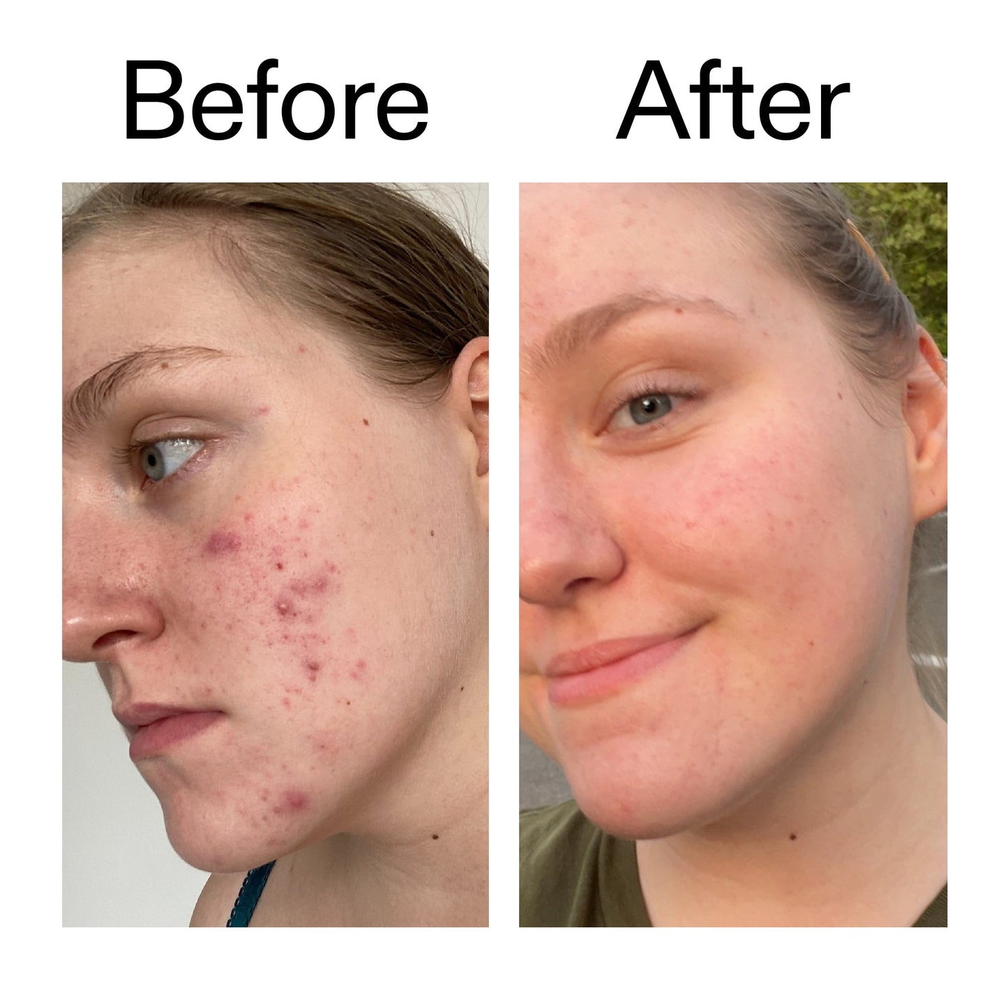glycolic-acid-toner-n6 Glycolic_Acid_Toner_Before_After_2000x2000_49f0b9f7-e71b-4b2e-a8f8-2ea4b73247bb.jpg