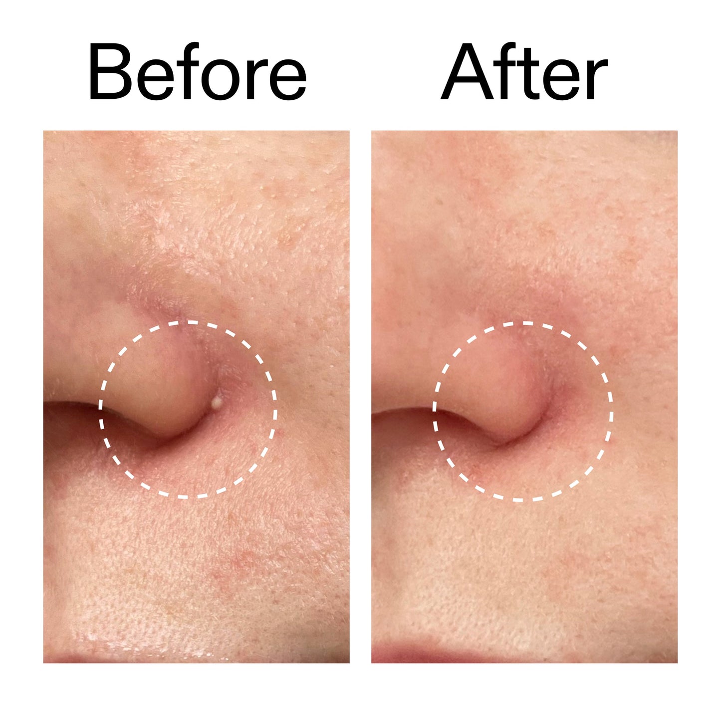 hydrocolloid-invisible-pimple-patches-pack-of-44-m2 Hydrocolloid_Invisible_Pimple_Patches_Before_After_2000x2000_b02aa37b-c78a-4682-91de-9135af5bb7df.jpg