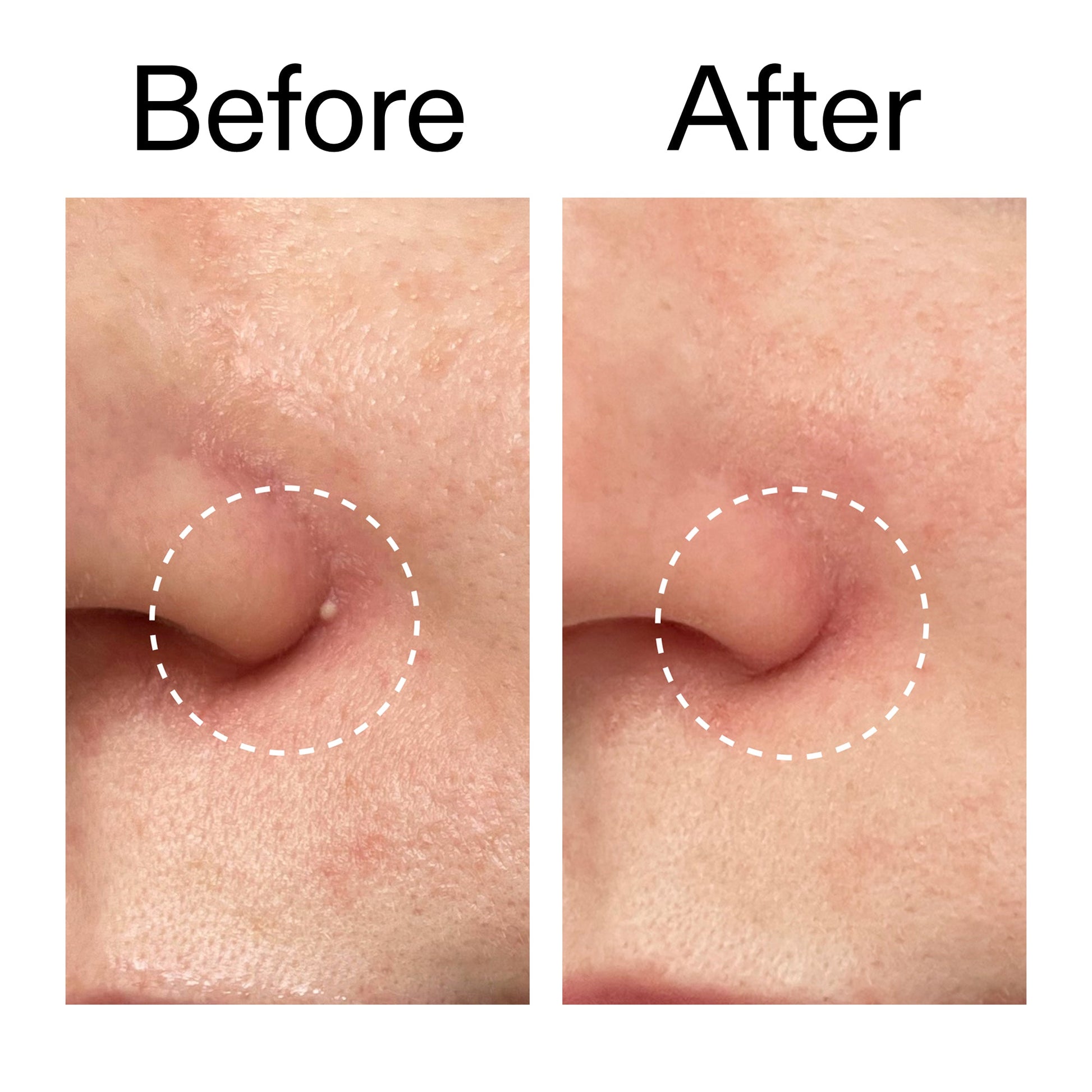 hydrocolloid-invisible-pimple-patches-pack-of-44-m2 Hydrocolloid_Invisible_Pimple_Patches_Before_After_2000x2000_b02aa37b-c78a-4682-91de-9135af5bb7df.jpg
