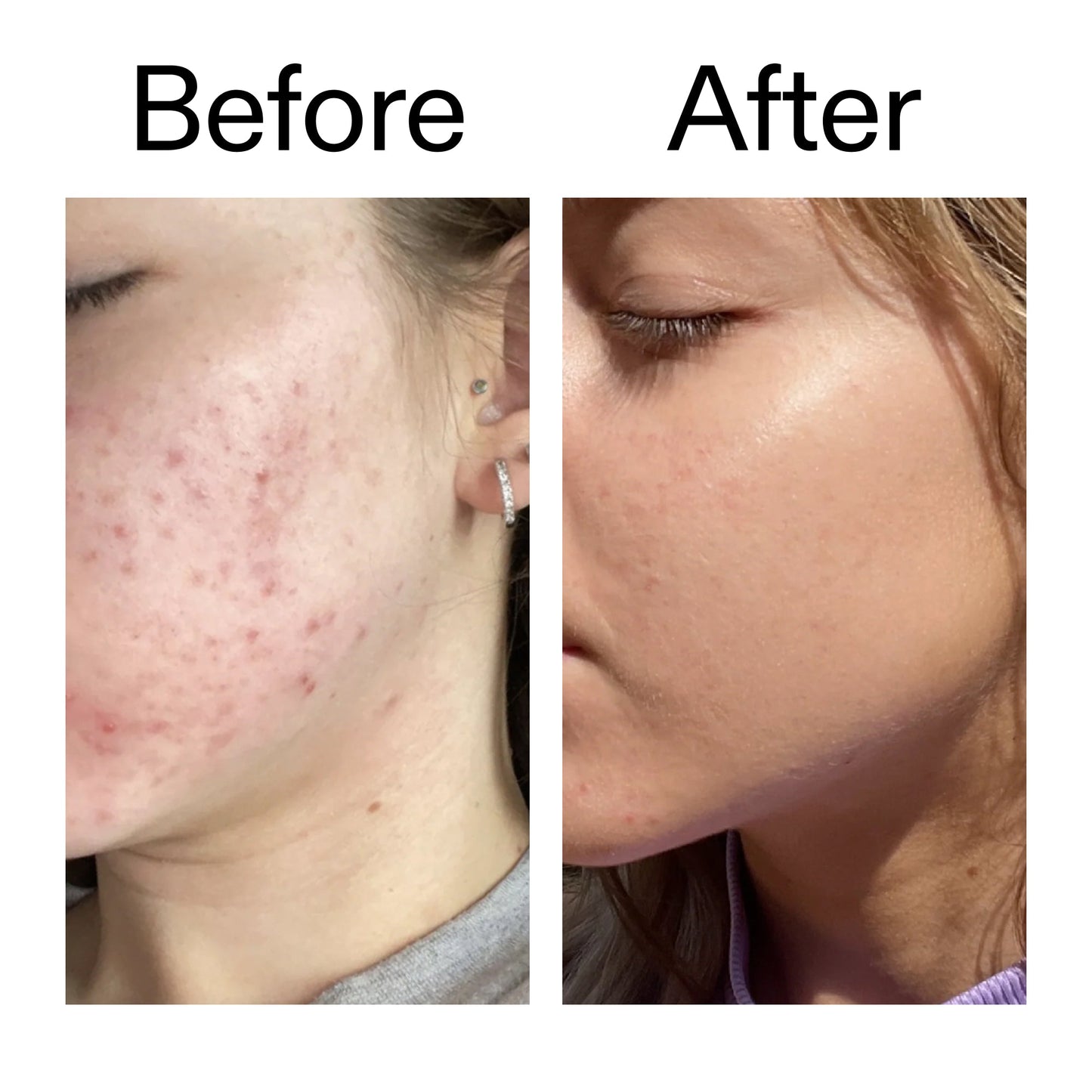 10-niacinamide-serum-duo-d0 Niacinamide_Serum_Before_After_2000x2000_bde32455-9e7d-448e-b053-bef41504f0a9.jpg