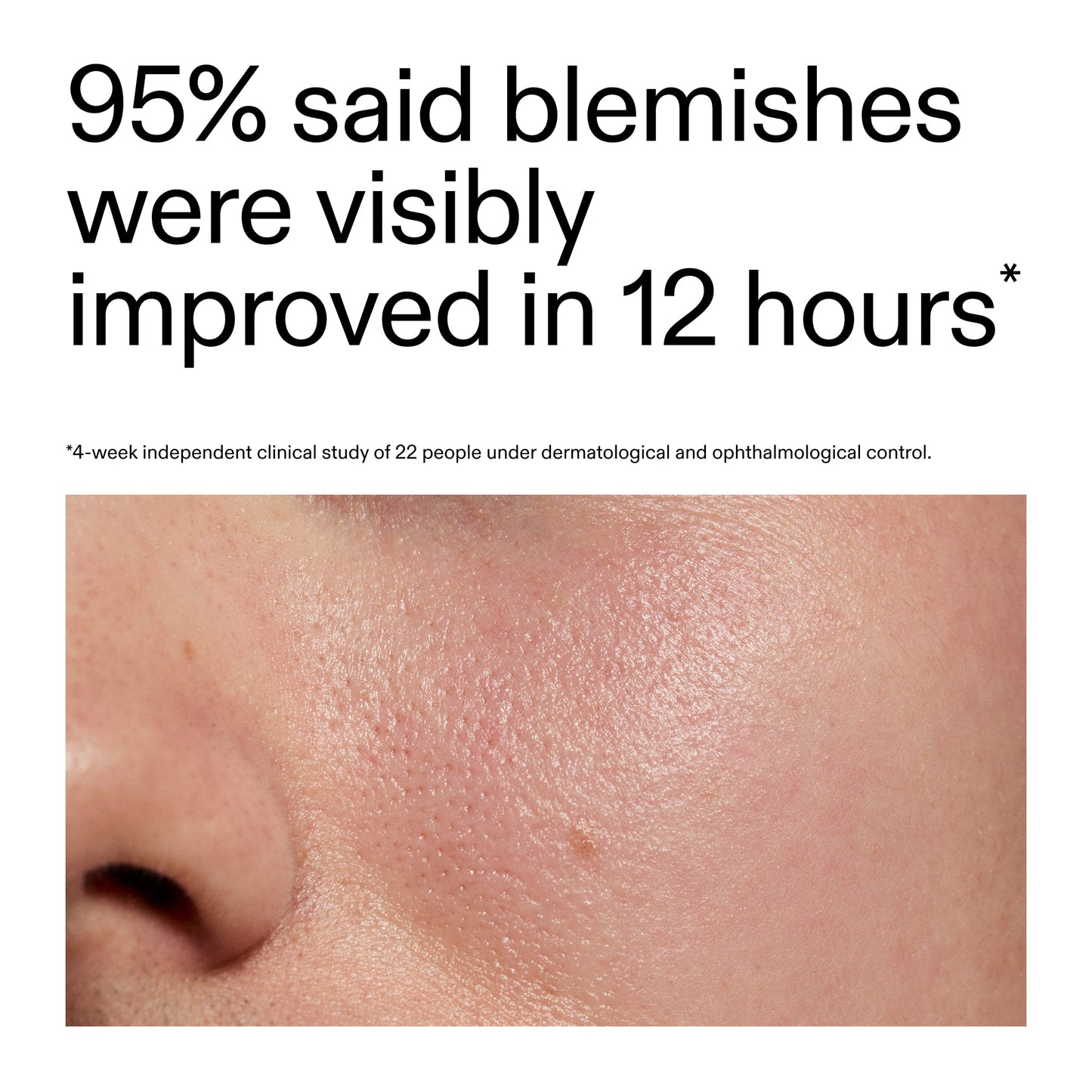 succinic-acid-acne-treatment-t3 Oat_Cleansing_Balm_Claim_2000x2000_ac6ce553-25db-41b2-a981-faae1ac4b8c0.jpg