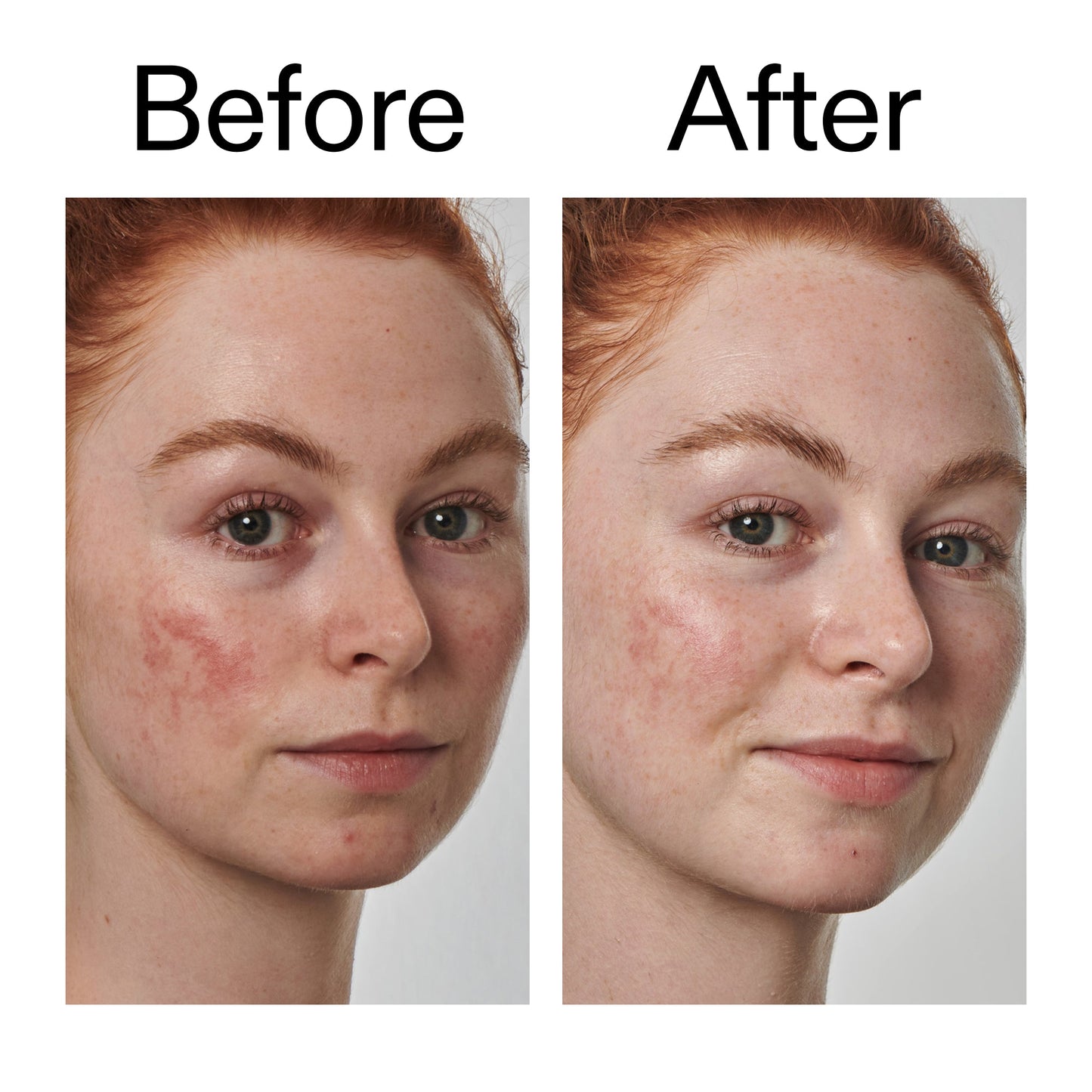 10-azelaic-acid-serum-for-redness-relief-x0 Redness_Relief_Serum_Before_After_2000x2000_3334dc9a-cce9-4e00-8aec-7ad89ca051f2.jpg