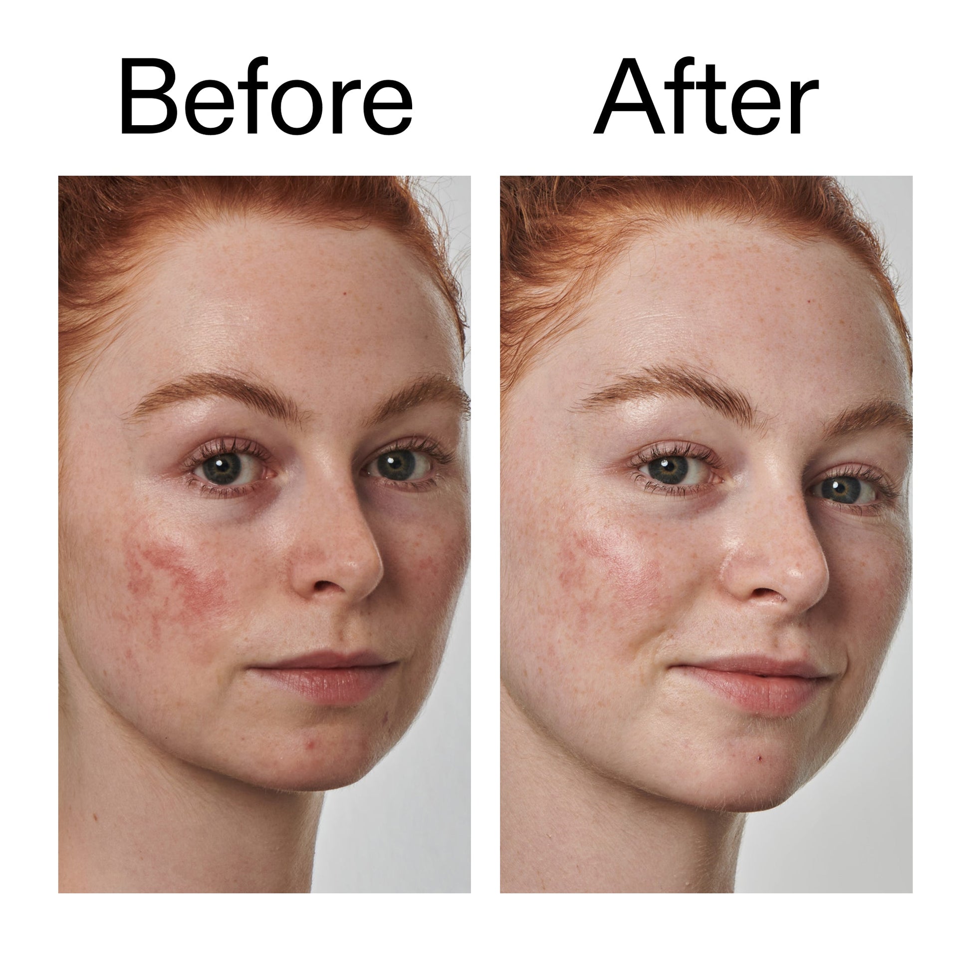 10-azelaic-acid-serum-for-redness-relief-x0 Redness_Relief_Serum_Before_After_2000x2000_3334dc9a-cce9-4e00-8aec-7ad89ca051f2.jpg