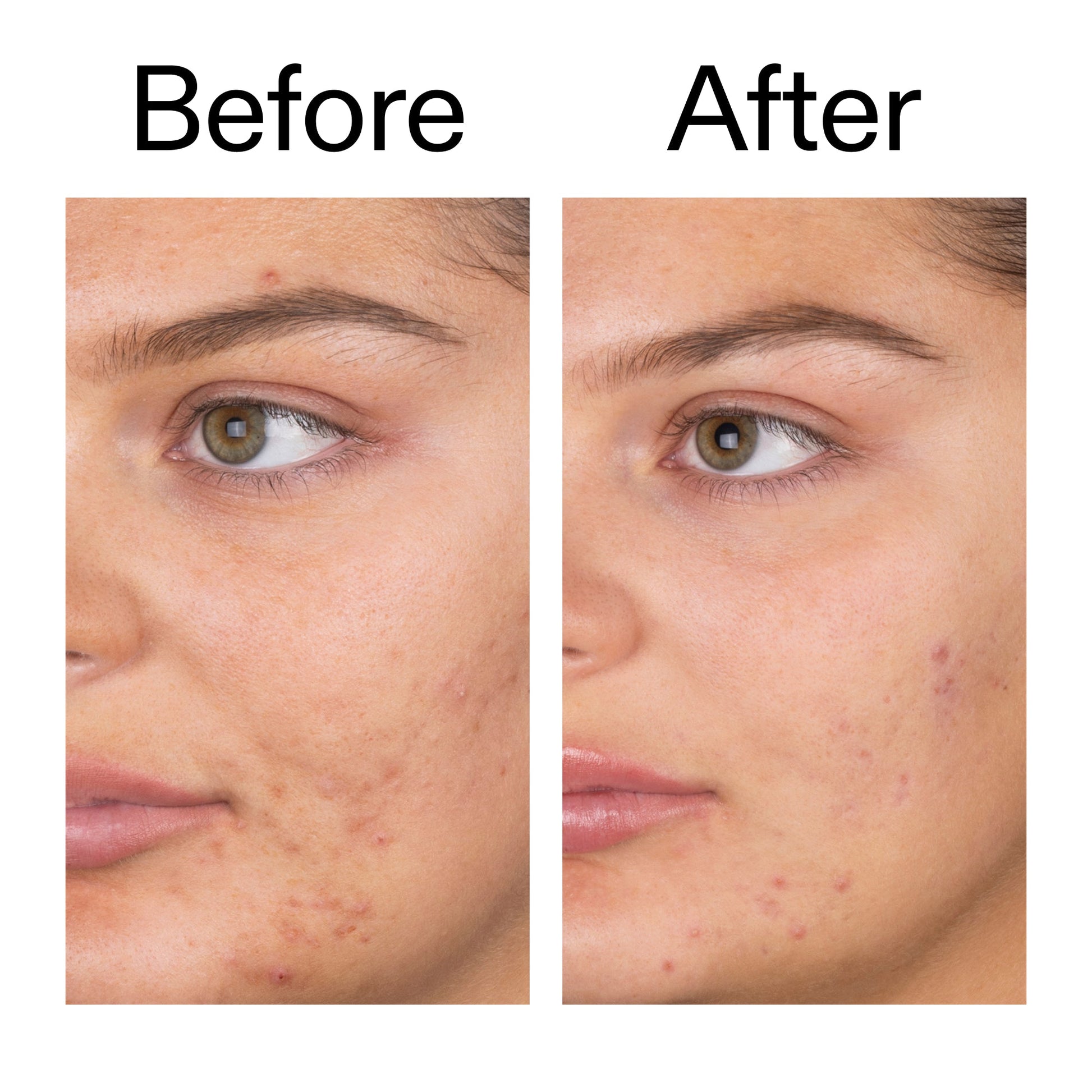 salicylic-acid-cleanser-150ml-d5 Salicylic_Acid_Cleanser_-_150ml_Before_After_2000x2000_e7230494-853f-4b07-82b1-27669104c995.jpg