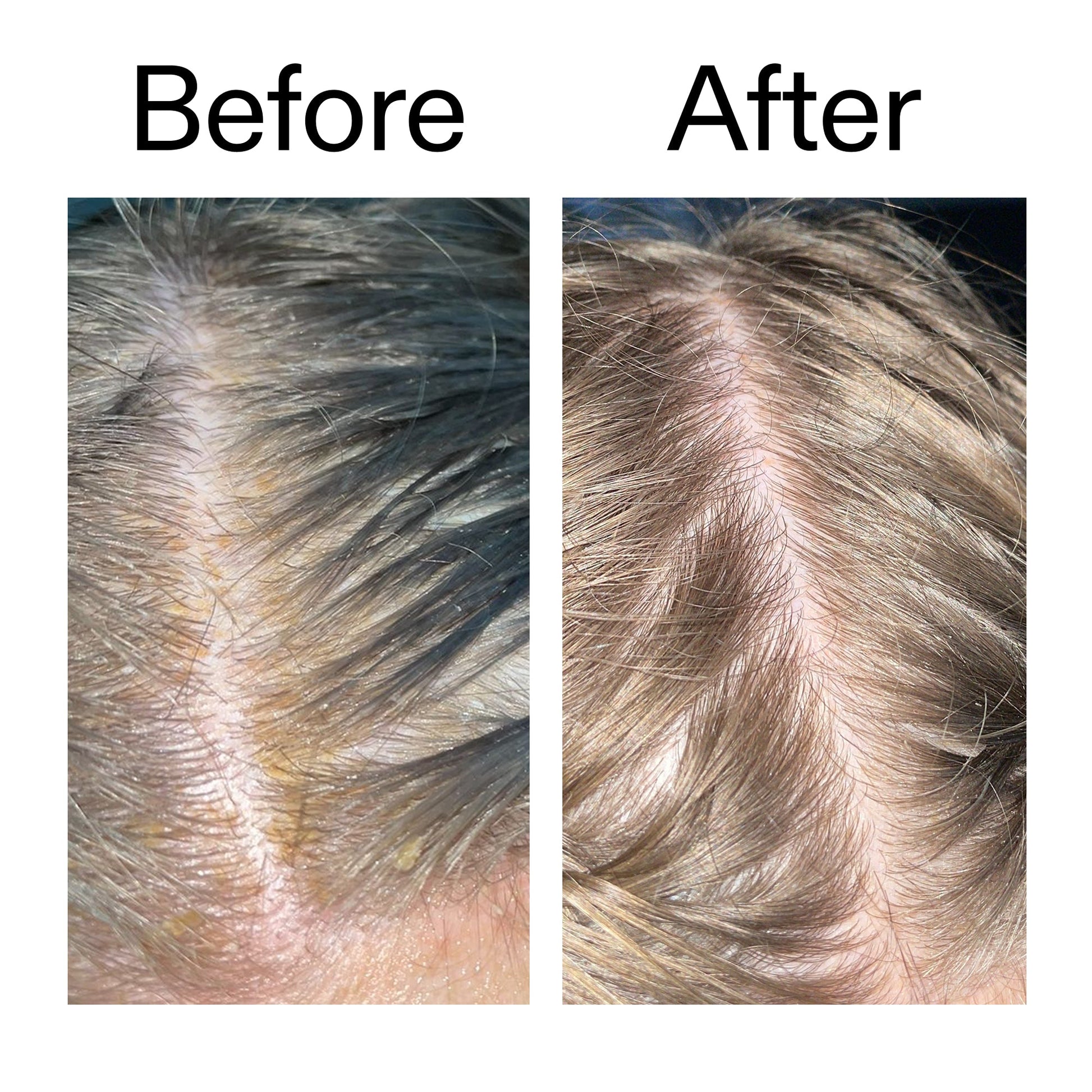 salicylic-acid-exfoliating-scalp-treatment-q6 Salicylic_Acid_Exfoliating_Scalp_Treatment_Before_After_2000x2000_e572a30f-057c-4a48-823b-1c09dc97f8d0.jpg