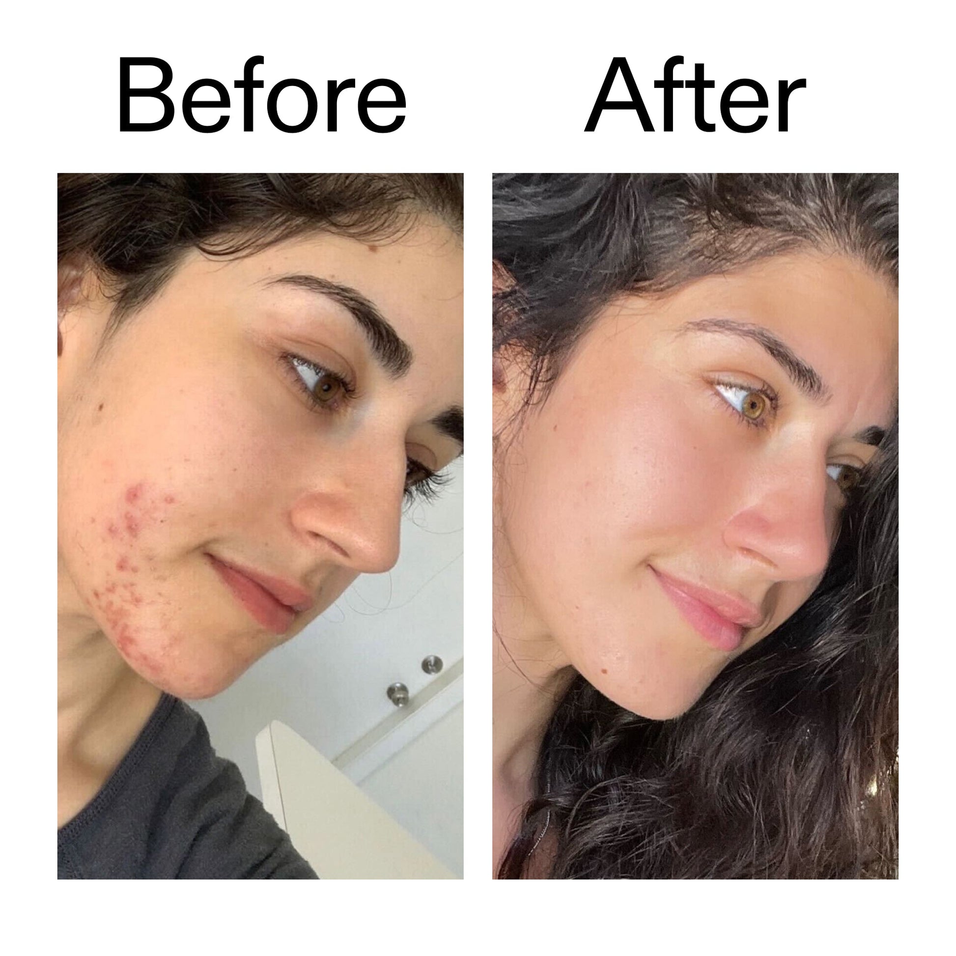 succinic-acid-acne-treatment-t3 Succinic_Acid_Treatment_Before_After_2000x2000_6a5f0054-2f58-4433-9314-0dc72c9bdd3b.jpg