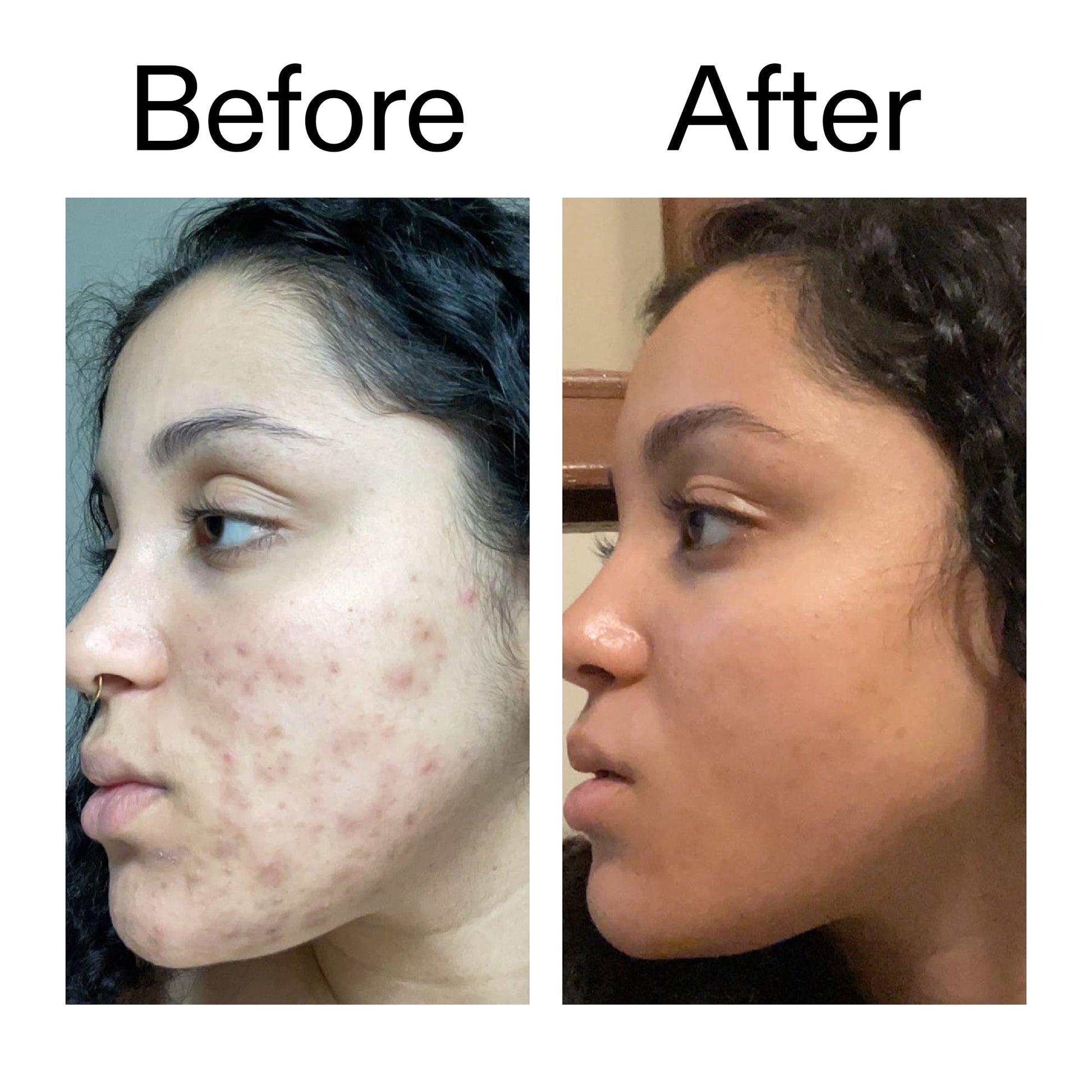 tranexamic-acid-serum-r9 Tranexamic_Acid_Serum_Before_After_2000x2000_98ebc8be-77b0-4843-8a22-90790ebe918b.jpg